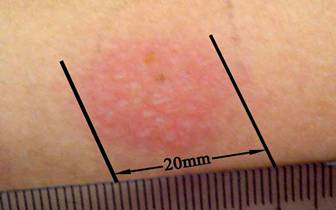 skin allergy testing #11